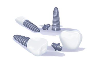 Types of Dental Implants: Houston Specialist