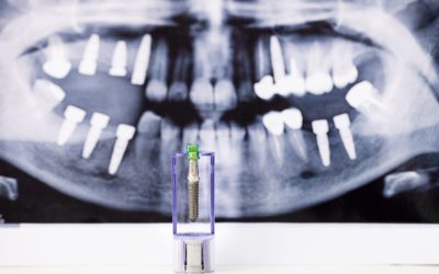 Missing Teeth? Get Dental Implants!