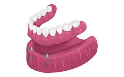 Finding The Perfect Dentures in All of Houston, TX